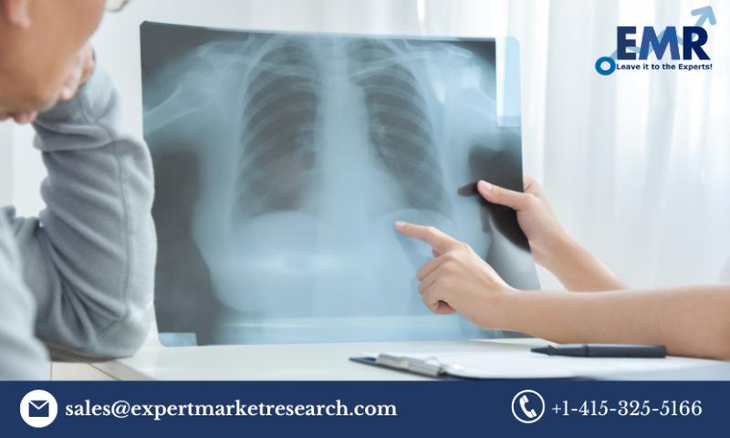 Global Pleural Effusion Treatment Market Size to Grow at a CAGR