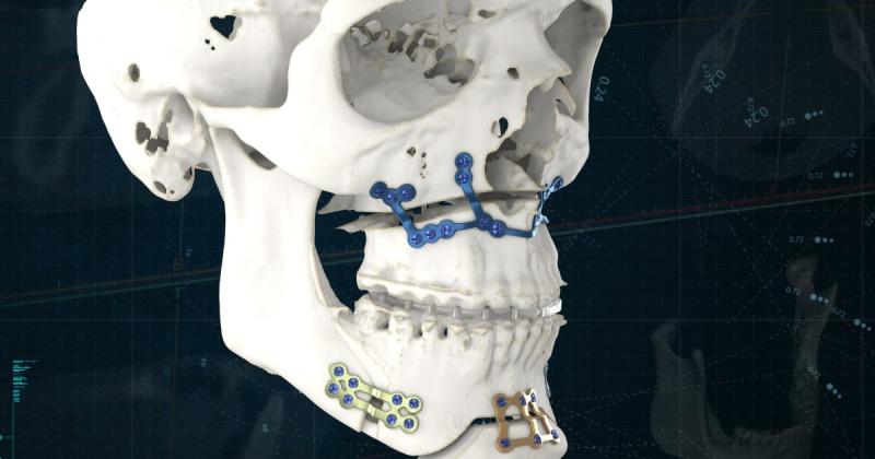 Cast Saw Devices Market to Witness Stunning Growth to Generate