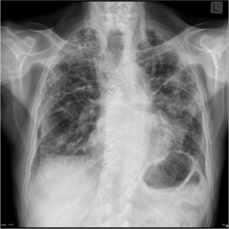 Idiopathic Pulmonary Fibrosis (IPF) Market Size Share Revenue