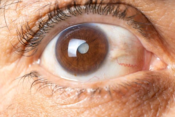 Chronic Ocular Graft-versus-host Disease Market