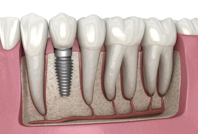 Dental Implants Market