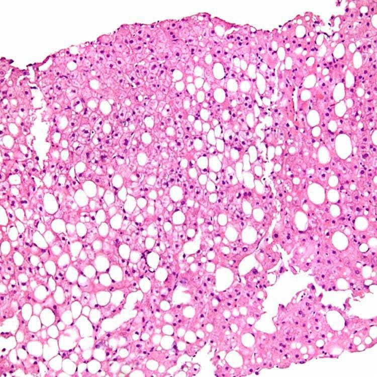 Nonalcoholic Steatohepatitis Therapeutics Market,Nonalcoholic Steatohepatitis Therapeutics Market Size