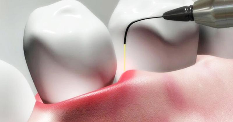 Periodontal Therapeutics Market, Periodontal Therapeutics Market Size, Periodontal Therapeutics Market Share