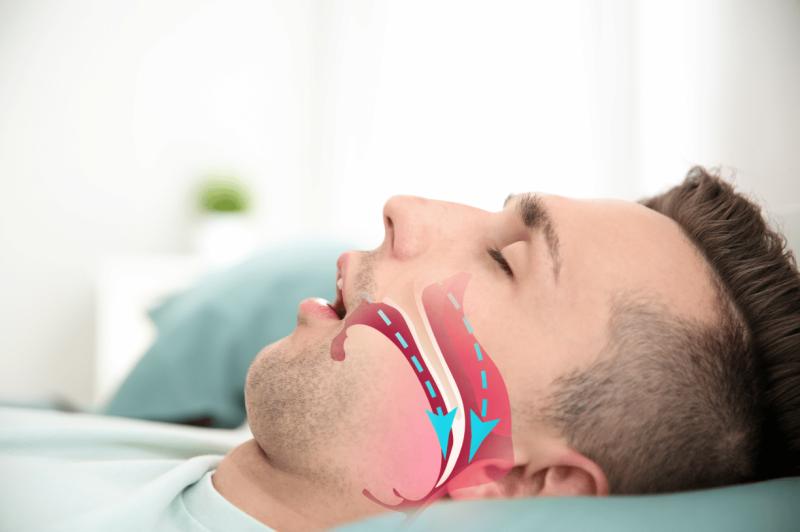 Sleep Apnea Implants Market