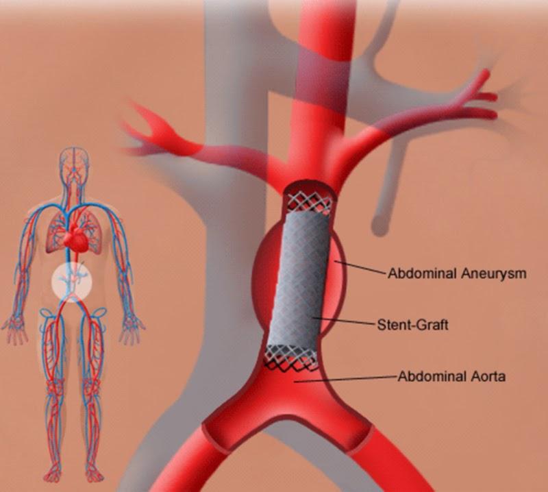 Endovascular Abdominal Aortic Aneurysm Repair Devices Market, Endovascular Abdominal Aortic Aneurysm Repair Devices Market Size