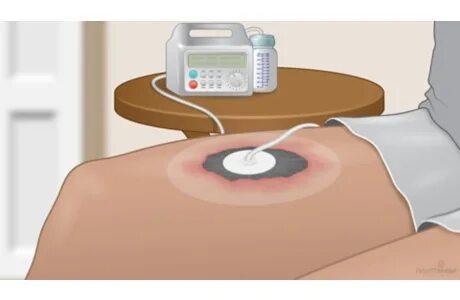 Europe Single-Use Negative Pressure Wound Therapy Devices Market