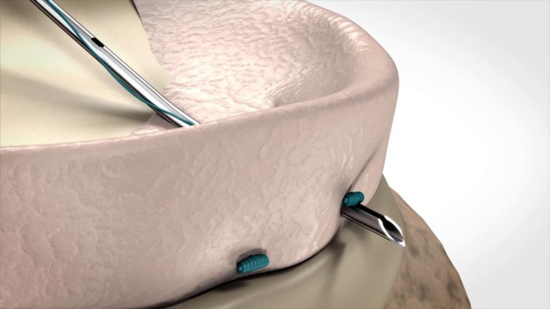 Orthopedic Soft Tissue Repair Market, Orthopedic Soft Tissue Repair Market Size, Orthopedic Soft Tissue Repair Market Share