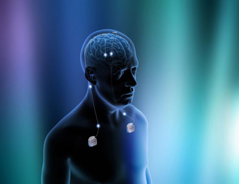Deep Brain Stimulation Devices Market, Deep Brain Stimulation Devices Size, Deep Brain Stimulation Devices Share