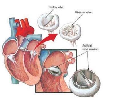 Artificial Tissue Heart Valve Market