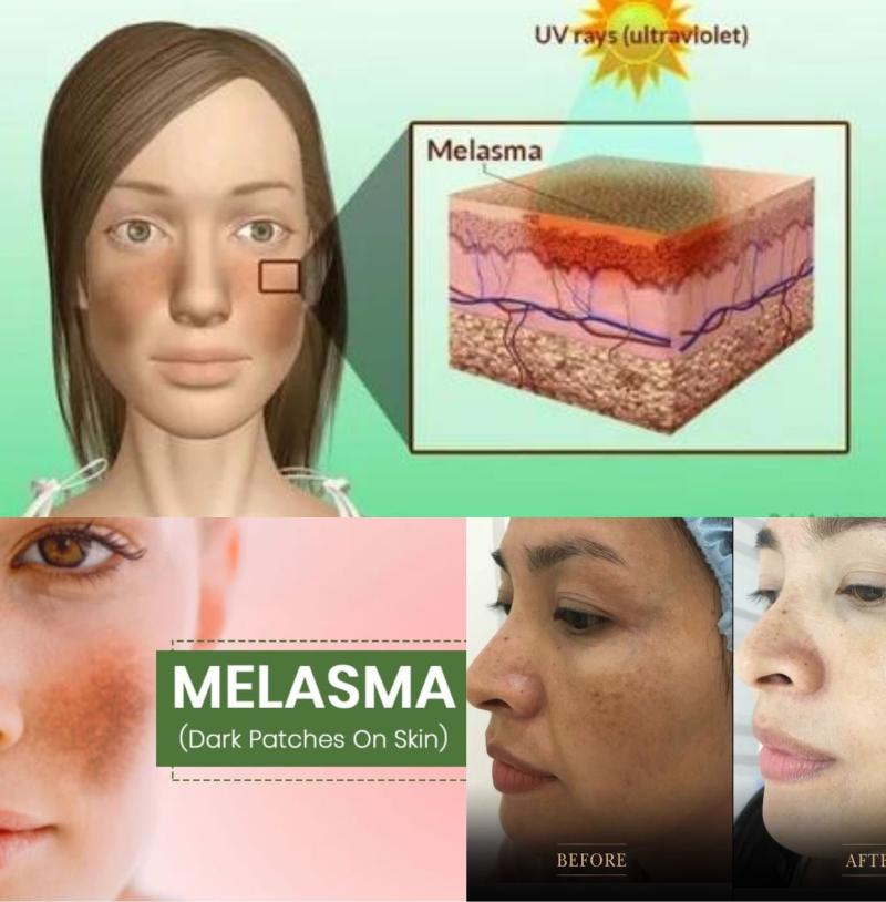 Melasma Drug Treatment Market