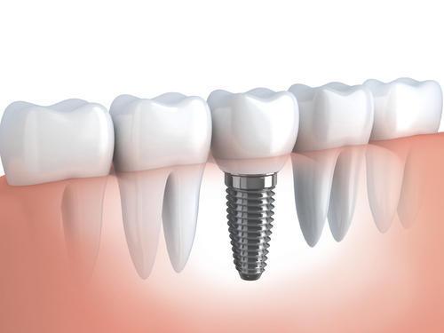 Dental Implants Market 2023 Industry Trends - Danaher, Dentsply