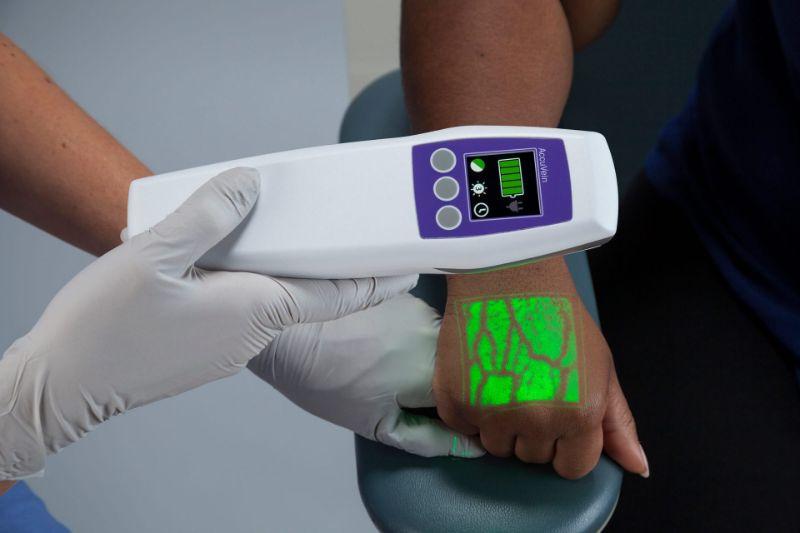 Vein Finder Market to See Booming Growth 2023-2030 | AccuVein