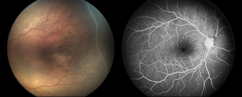 A Revolutionary Step Forward: Transforming Portable Retinal Imaging in Clinical Care with Fluorescein Angiography