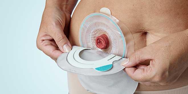 Ileostomy