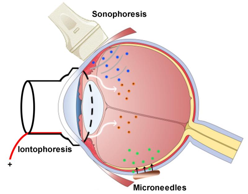 Ocular Drug Delivery Market