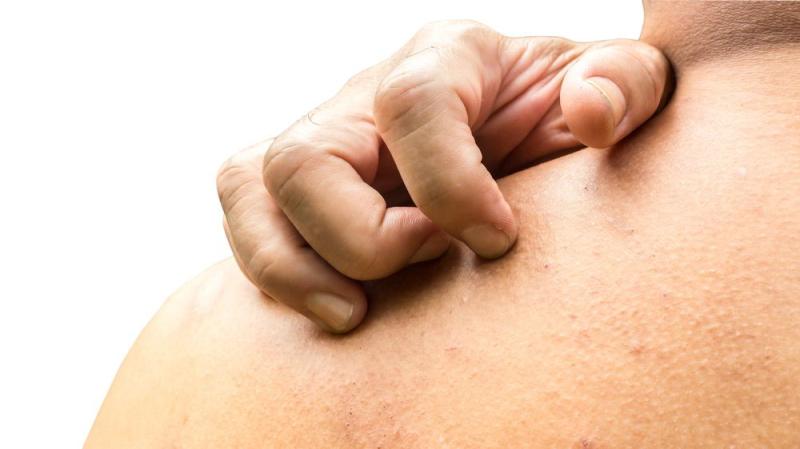 Global Chronic Pruritus Therapeutics Market Size, Share