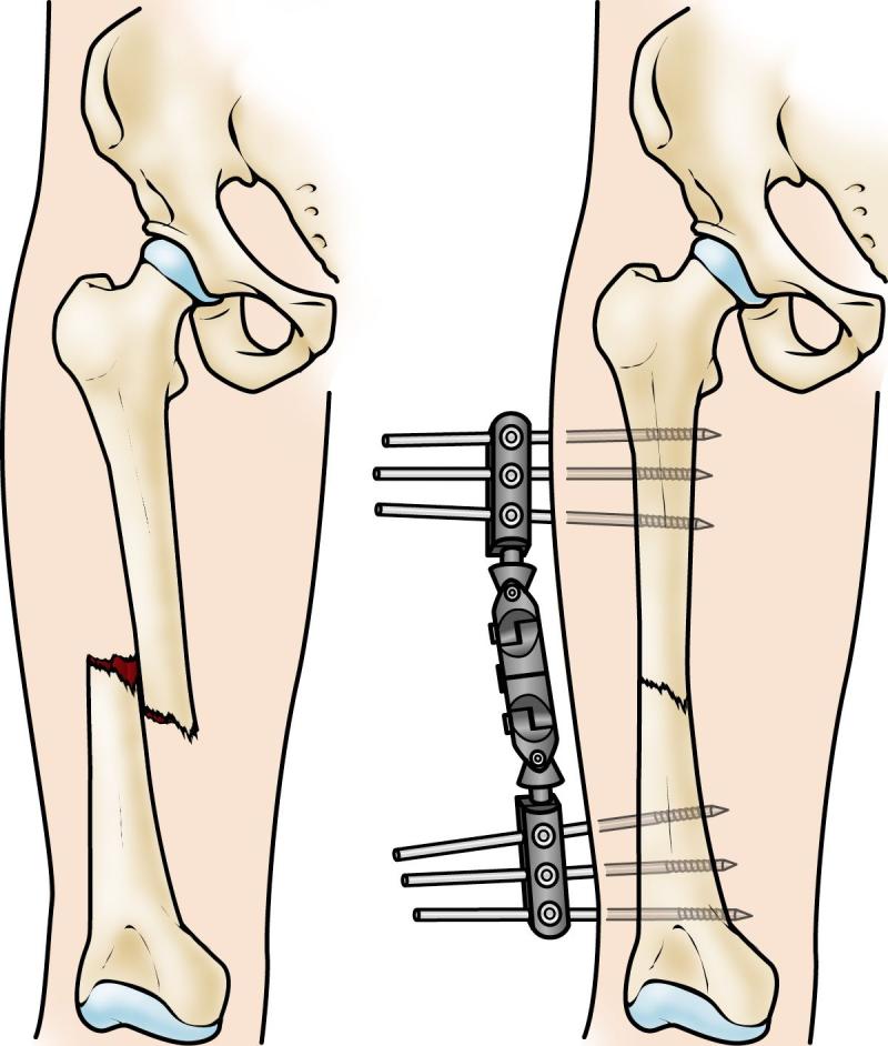 Orthopedic Fracture Repairing Implants for Osteoporosis market, Orthopedic Fracture Repairing Implants for Osteoporosis