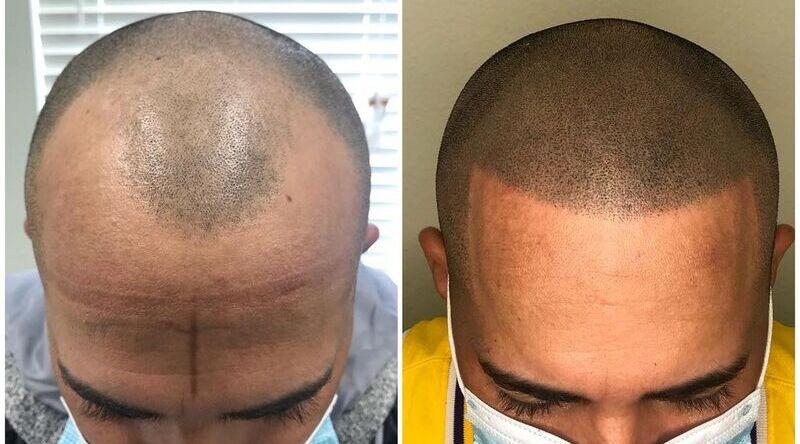 Neoaesthetica Offers Scalp Micropigmentation Hair Transplant