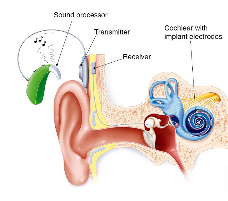 Cochlear Implant (Bionic Ear) Market Advances and Innovations