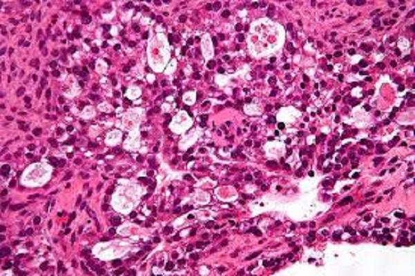 Ovarian Clear Cell Carcinoma Market Growth, Opportunity,