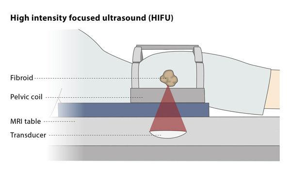 High Intensity Focused Ultrasound (HIFU) is Set to grow