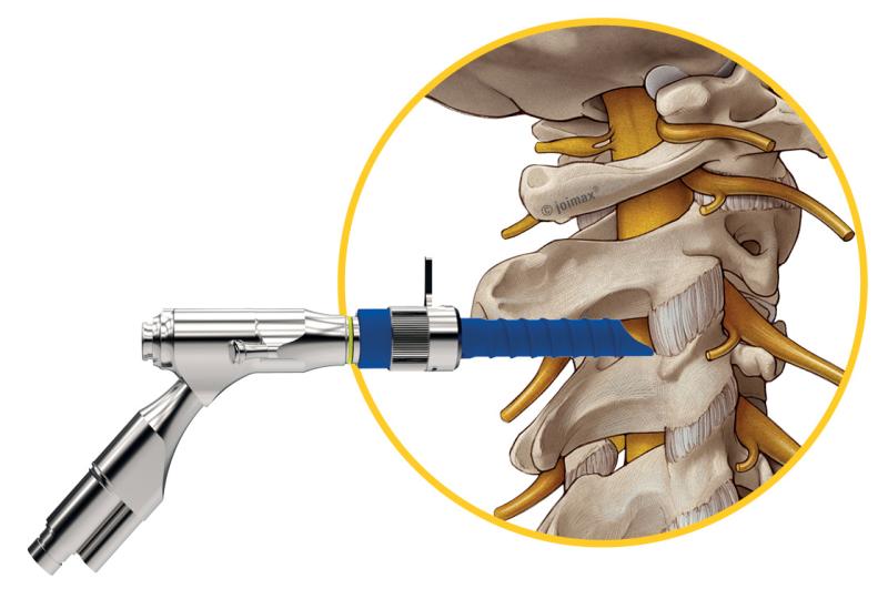 Spine Endoscope Market Outlook 2029 - Existing and Future Aspect