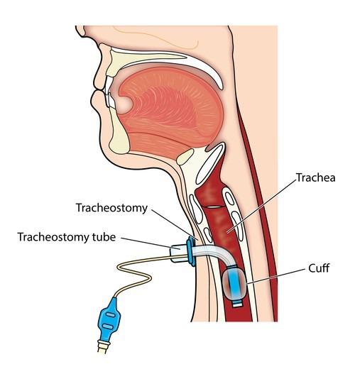 Tracheostomy Tube