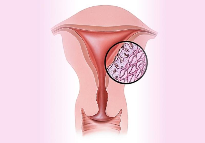 Dysmenorrhea Market Share, Epidemiology, Analysis & Trends