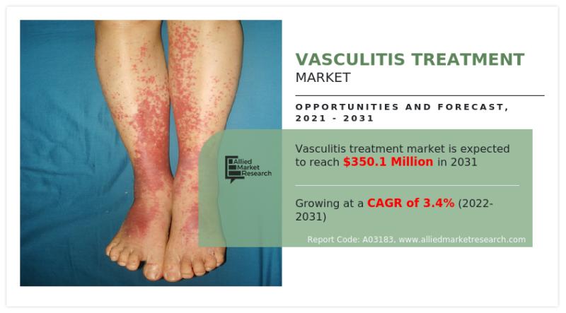 Vasculitis Treatment Market