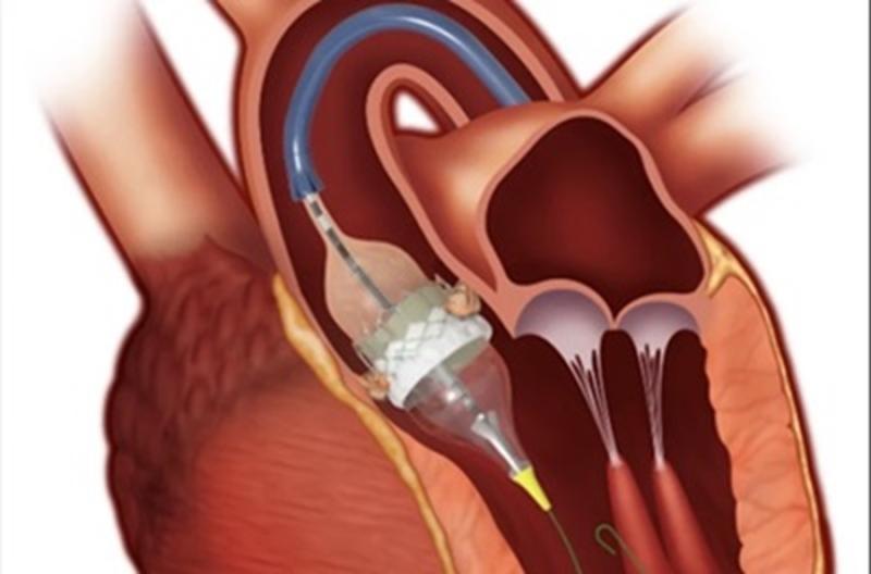 global Aortic Valve Replacement Devices market