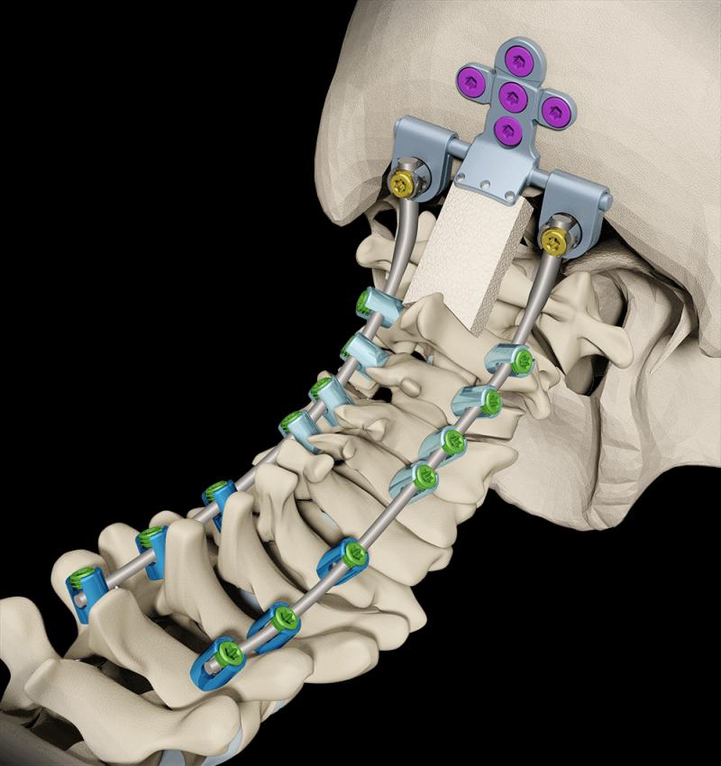 Spine Implant Market Top Growth Companies, Global Growth, Size,