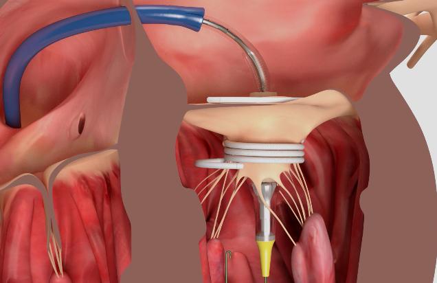 Transcatheter Heart Valve Replacement and Repair Market Size