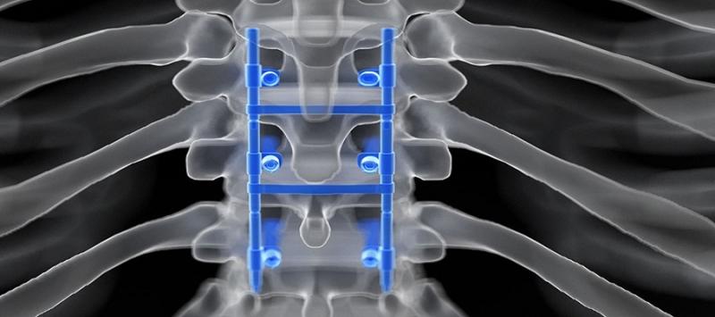 Spinal Fusion Devices Market Assessment: Growth Trajectory, Key Players, and Future Projections (2023-2030)