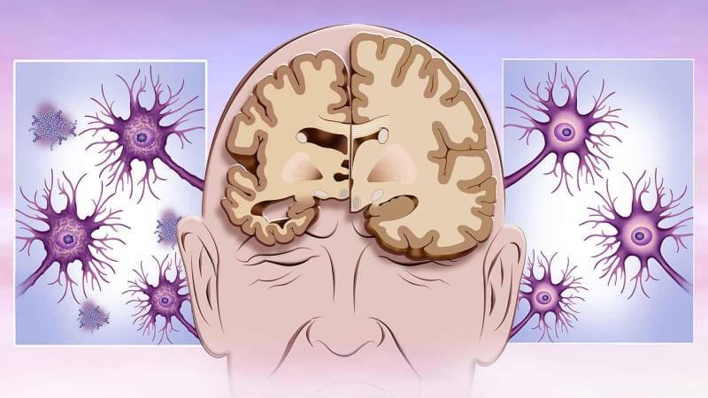 Alzheimer's Disease Market