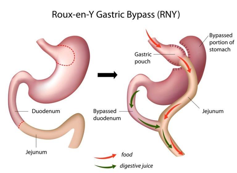 Mini Gastric Bypass: Faster Recovery, Fewer Risks, Long-Term Results
