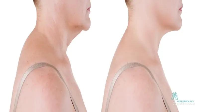 What Is a Buffalo Hump? Understanding the Condition and Surgical Solutions