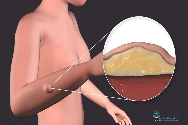 Understanding Lump and Bump Removal: When Is Surgery Needed?