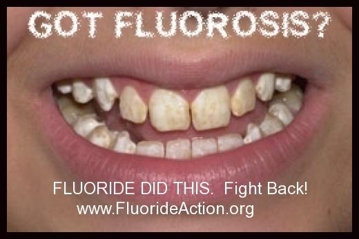 A picture of moderate dental fluorosis